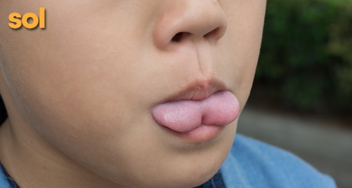 how a speech therapist can help with tongue tie in children | Sol Speech & Language Therapy | Austin Texas